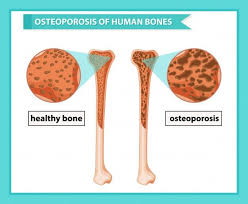 How to Prevent Osteoporosis with Pure Plates